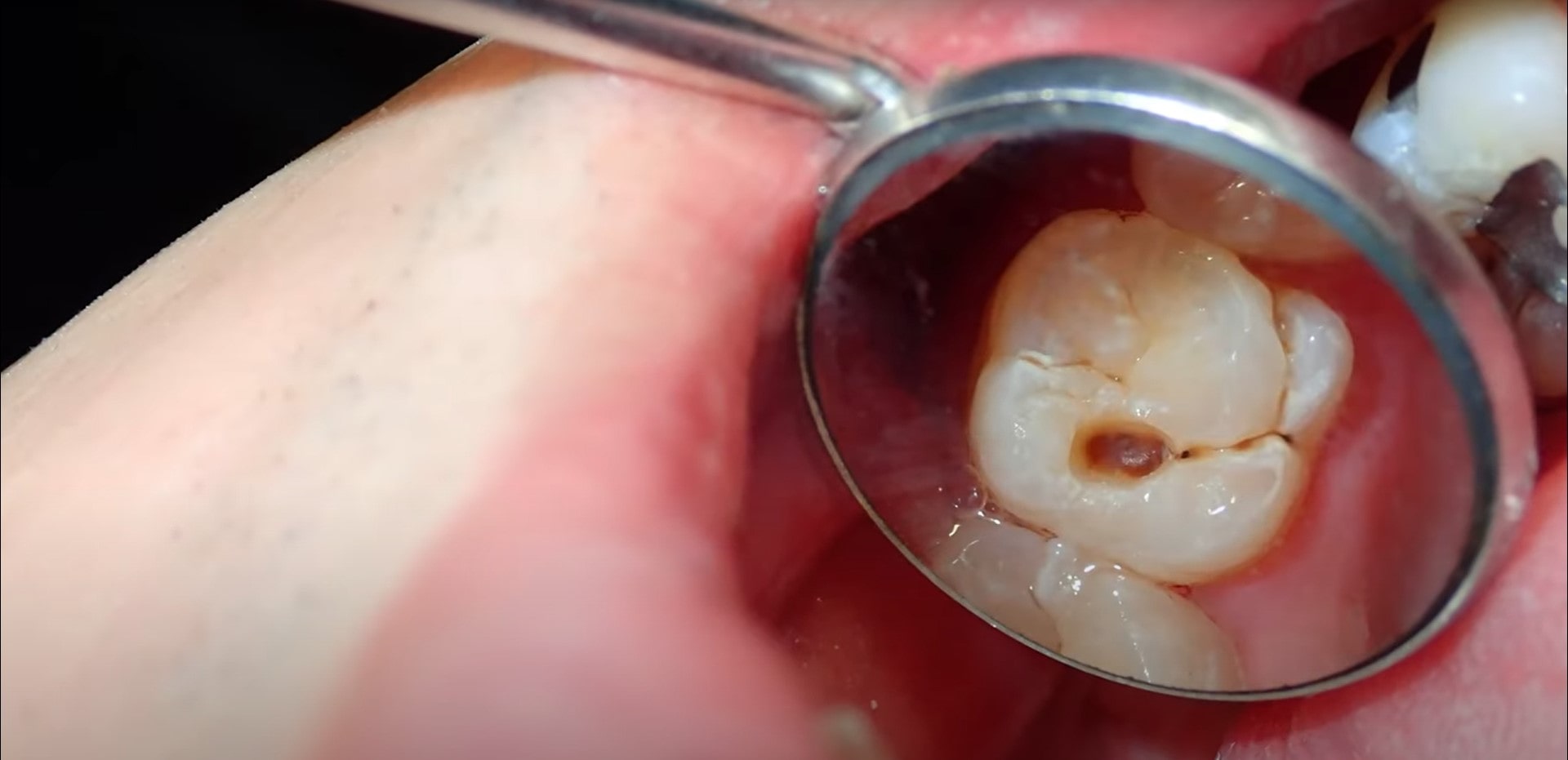 Understanding Tooth Decay Causes, Symptoms, and Treatment