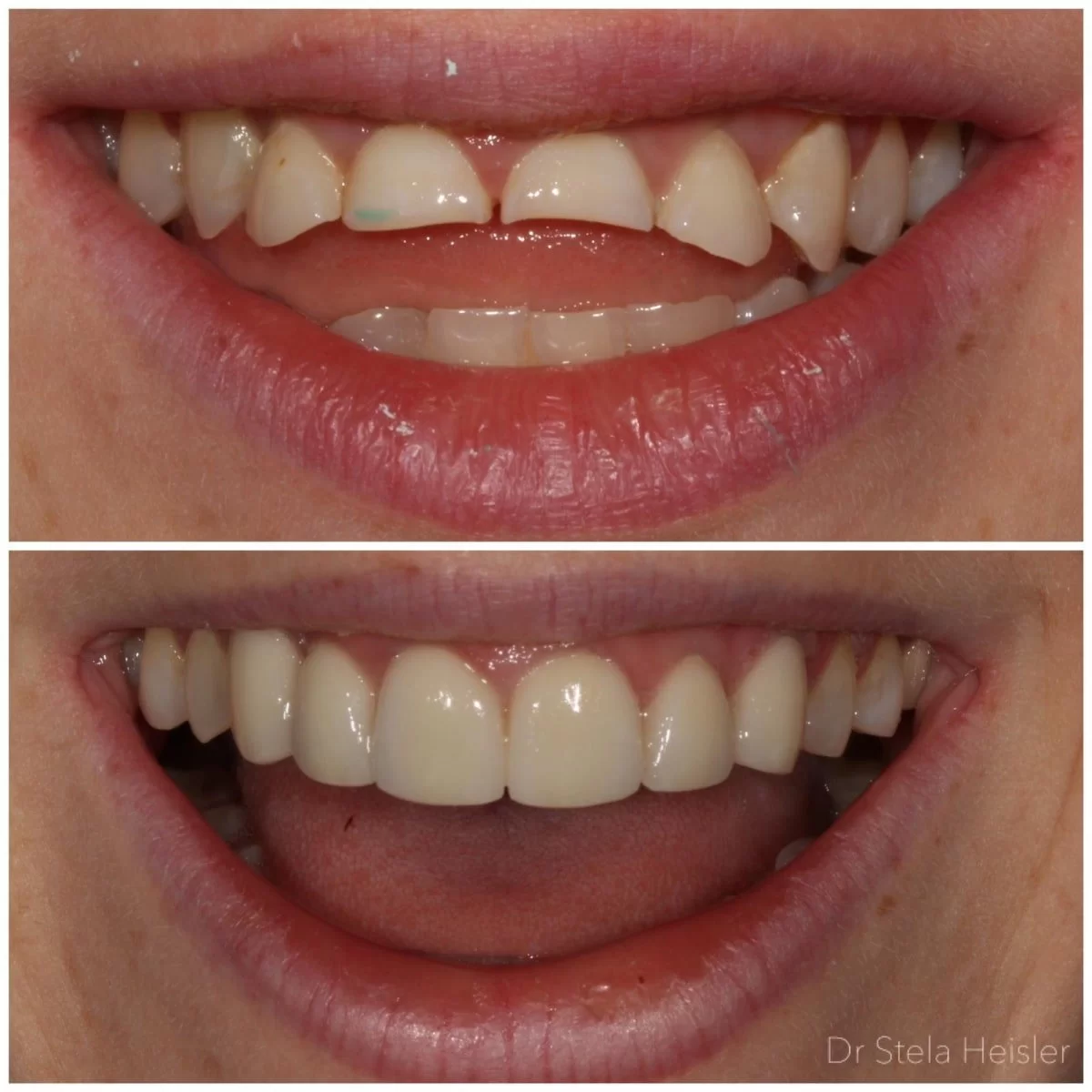 כתרי זירקוניה - תמונות לפני ואחרי