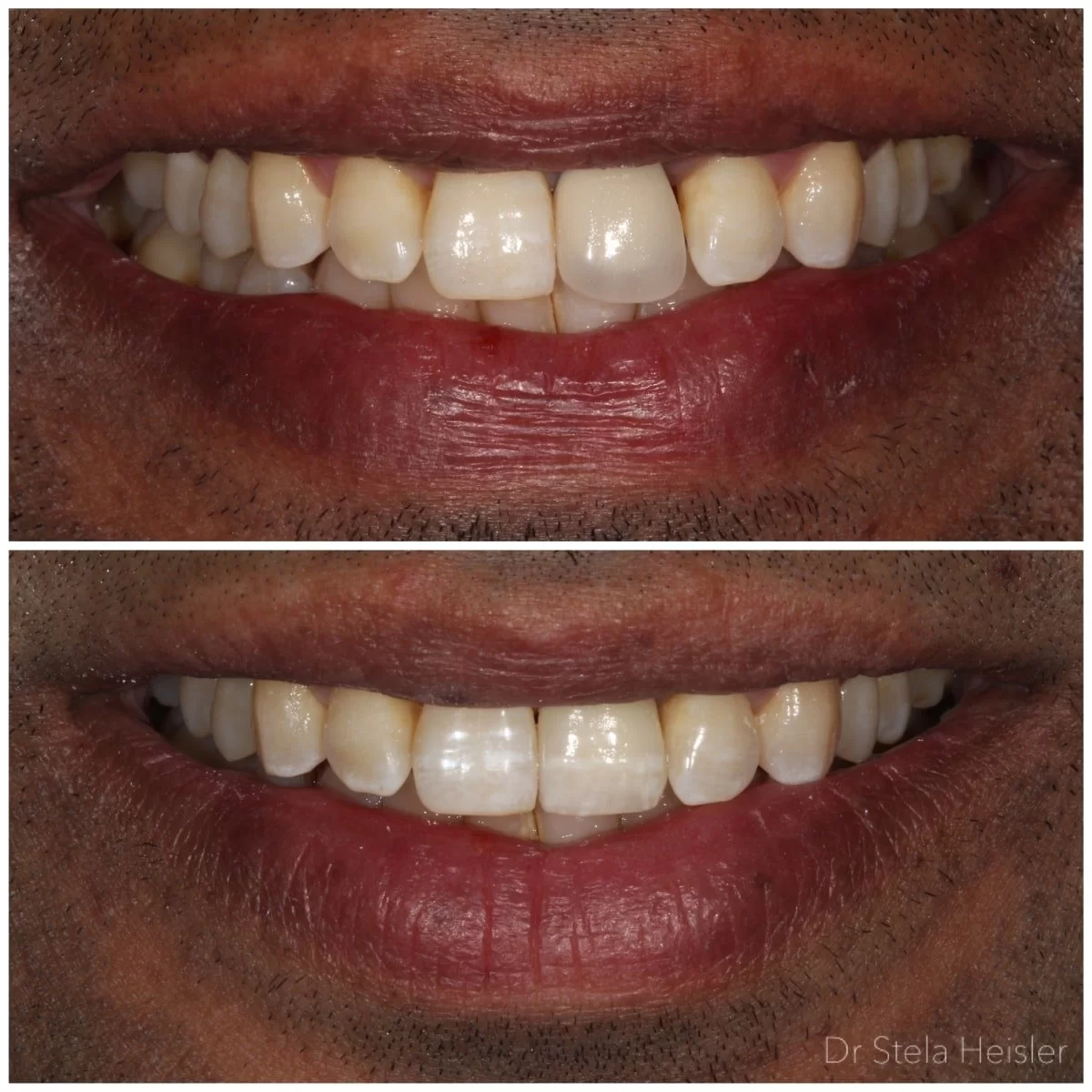 כתרי זירקוניה - תמונות לפני ואחרי