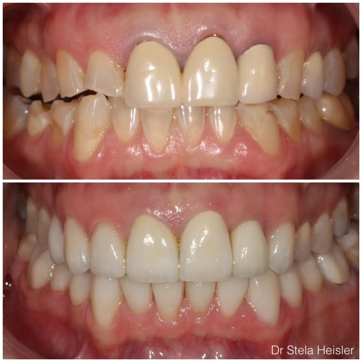 שיקום פה מלא - טיפול בשחיקת שיניים בירושלים