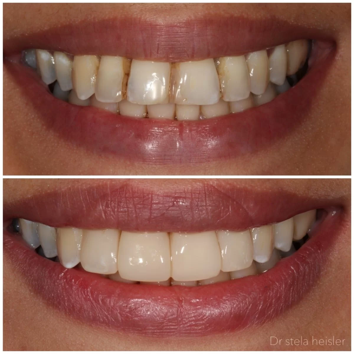 ציפויי קומפוזיט - תמונות לפני ואחרי