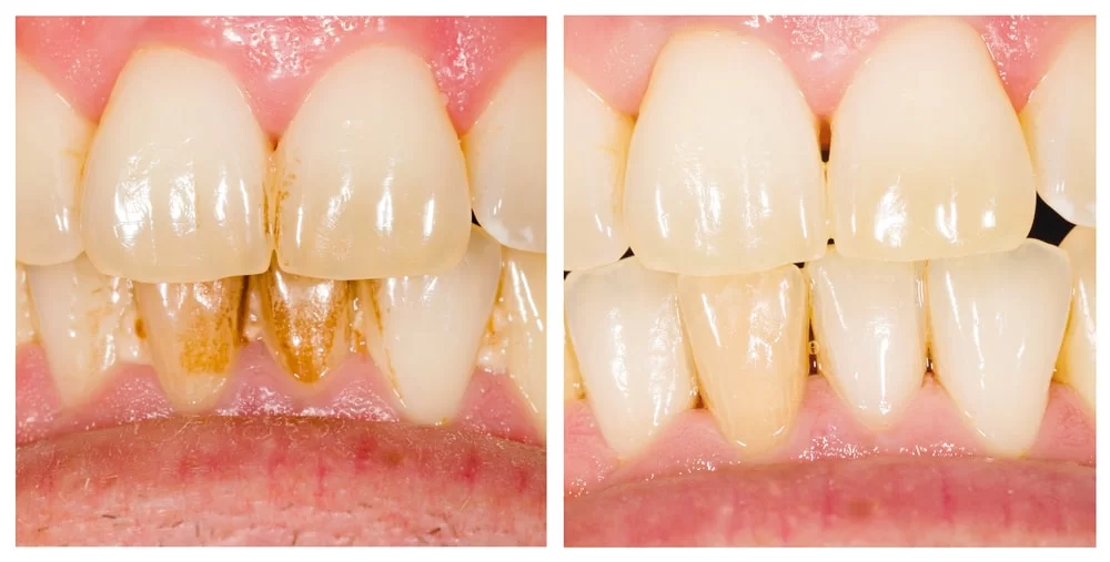 Before and after dental plaque removal treatment