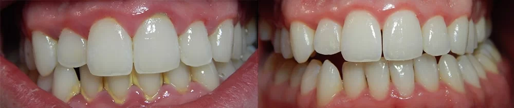 Gingivitis before and after