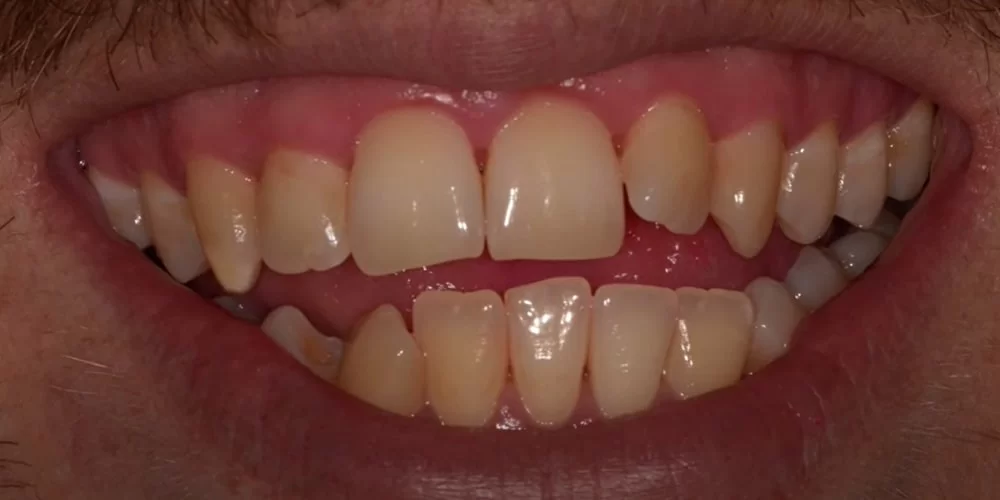 Gum infection after