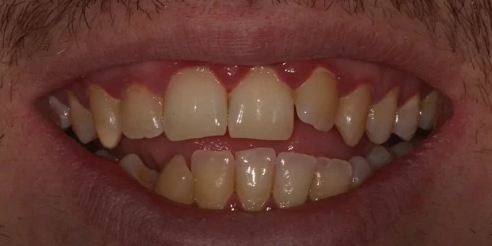 Gum infection before