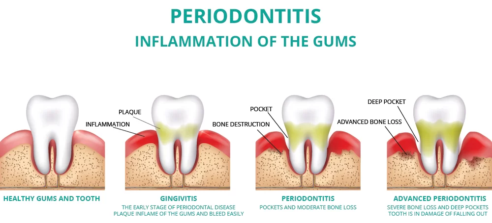 Periodontitis and inflammation of the gums, detailed illustration