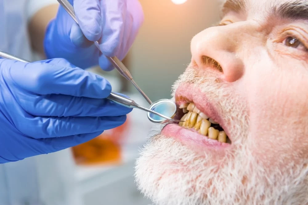 Tooth discoloration - the first and most evident impact of smoking on oral health