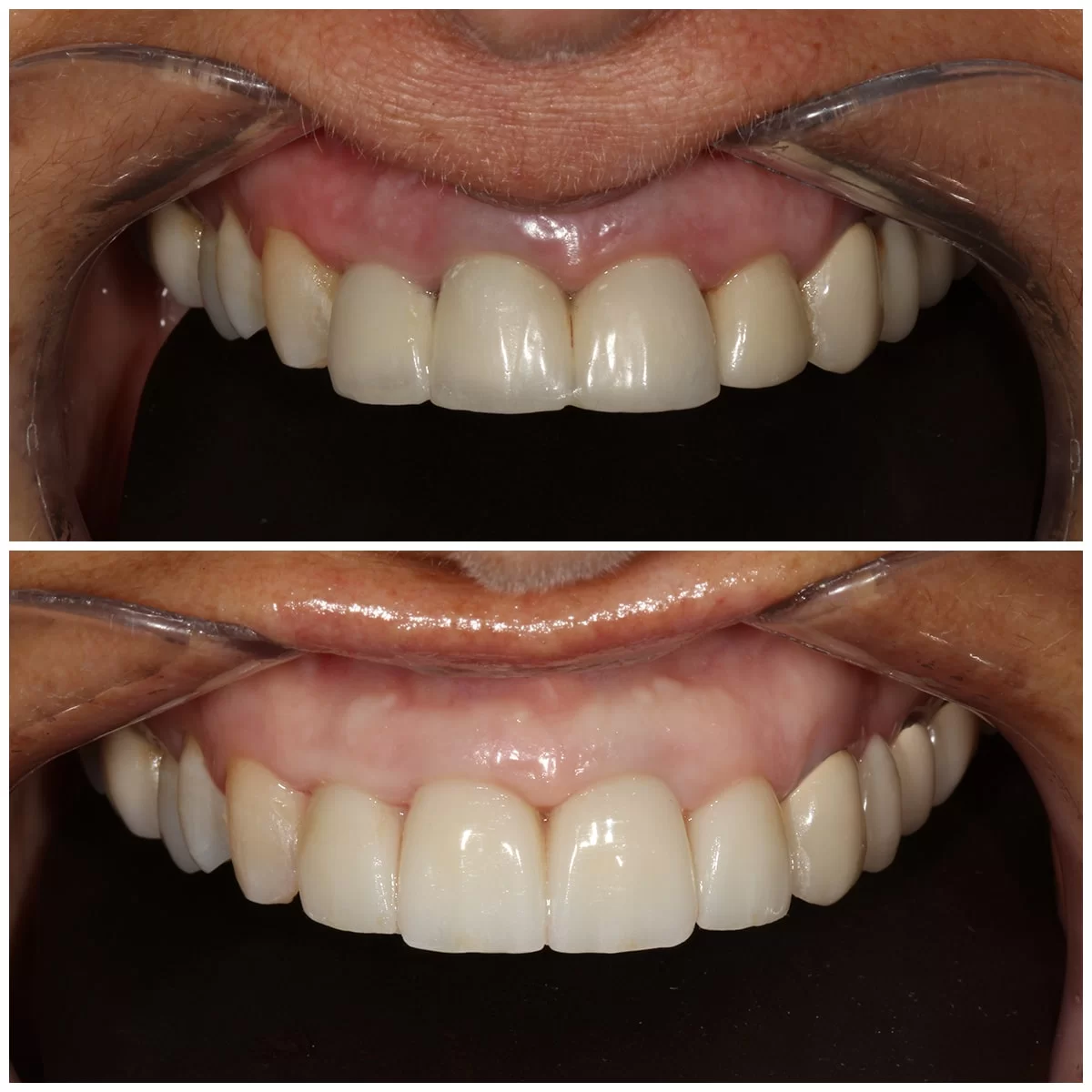 החלפת 4 כתרים ישנים עם כתרי זירקוניה חדשים - תמונה לפני ואחרי