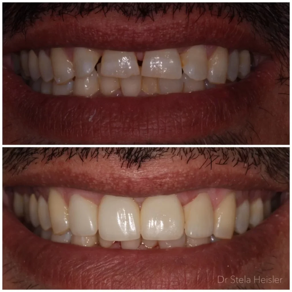 שיפור האסתטיקה של השיניים באמצעות ציפויי חרסינה לשיניים