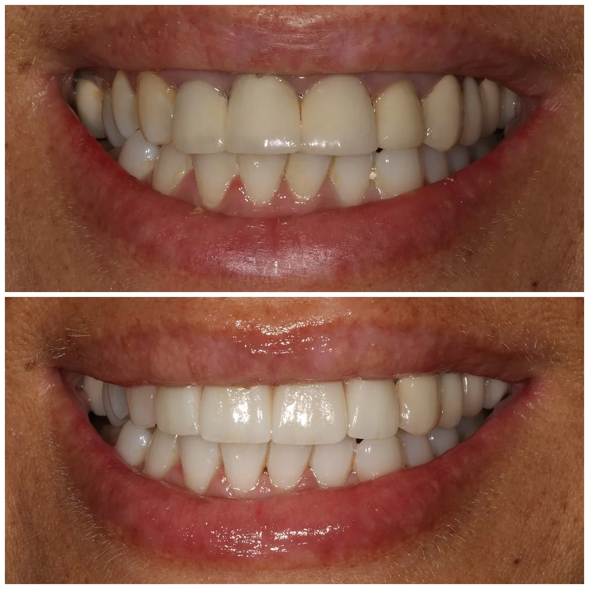 כתרי זירקוניה - תמונות לפני ואחרי