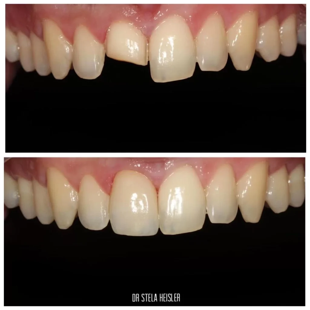 Dental veneers for chipped or broken teeth