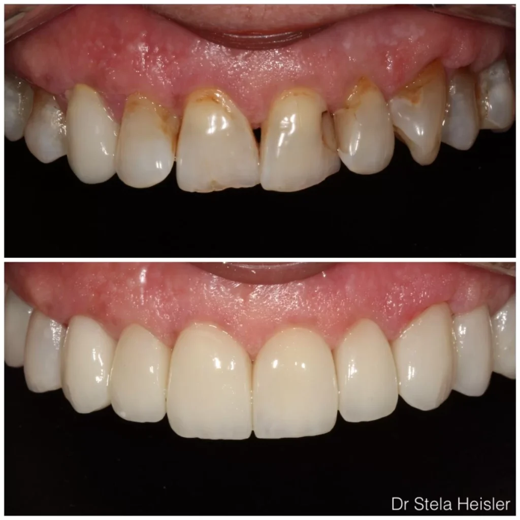 Dental veneers for discolored teeth