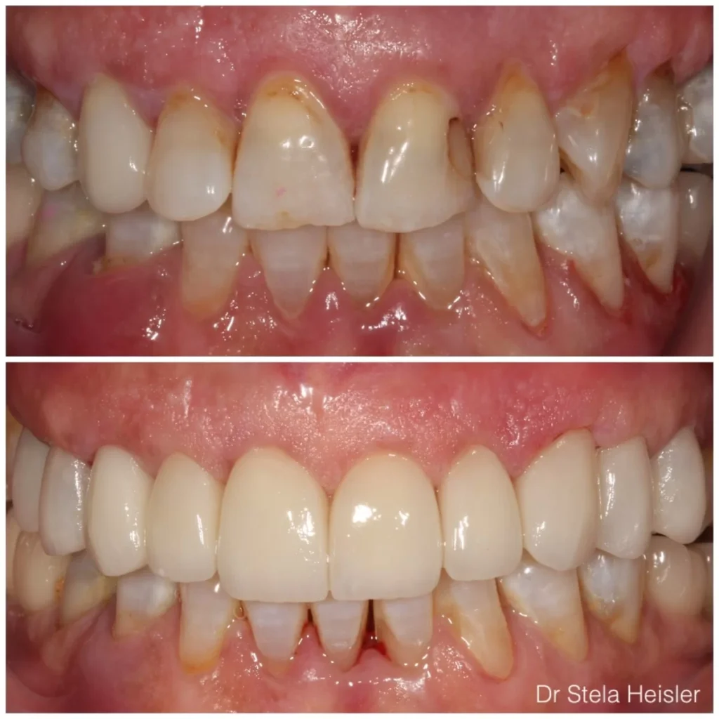 Dental veneers to correct the shape of the tooth and correct the color of the tooth