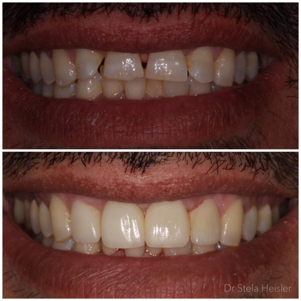 Improving the aesthetics of the teeth using porcelain coatings for the teeth