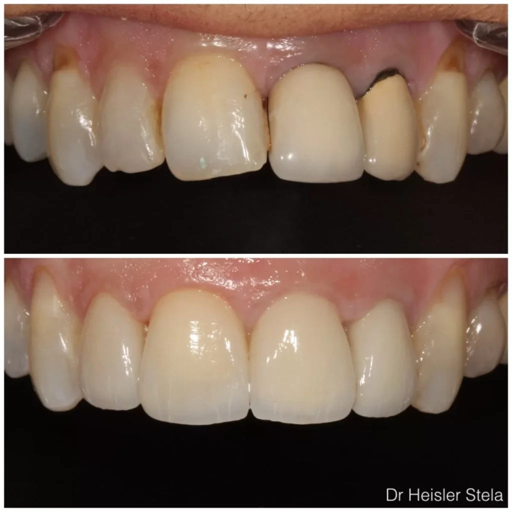 Porcelain veneers for an aesthetic appearance and to cover the grayness that has formed around the gums