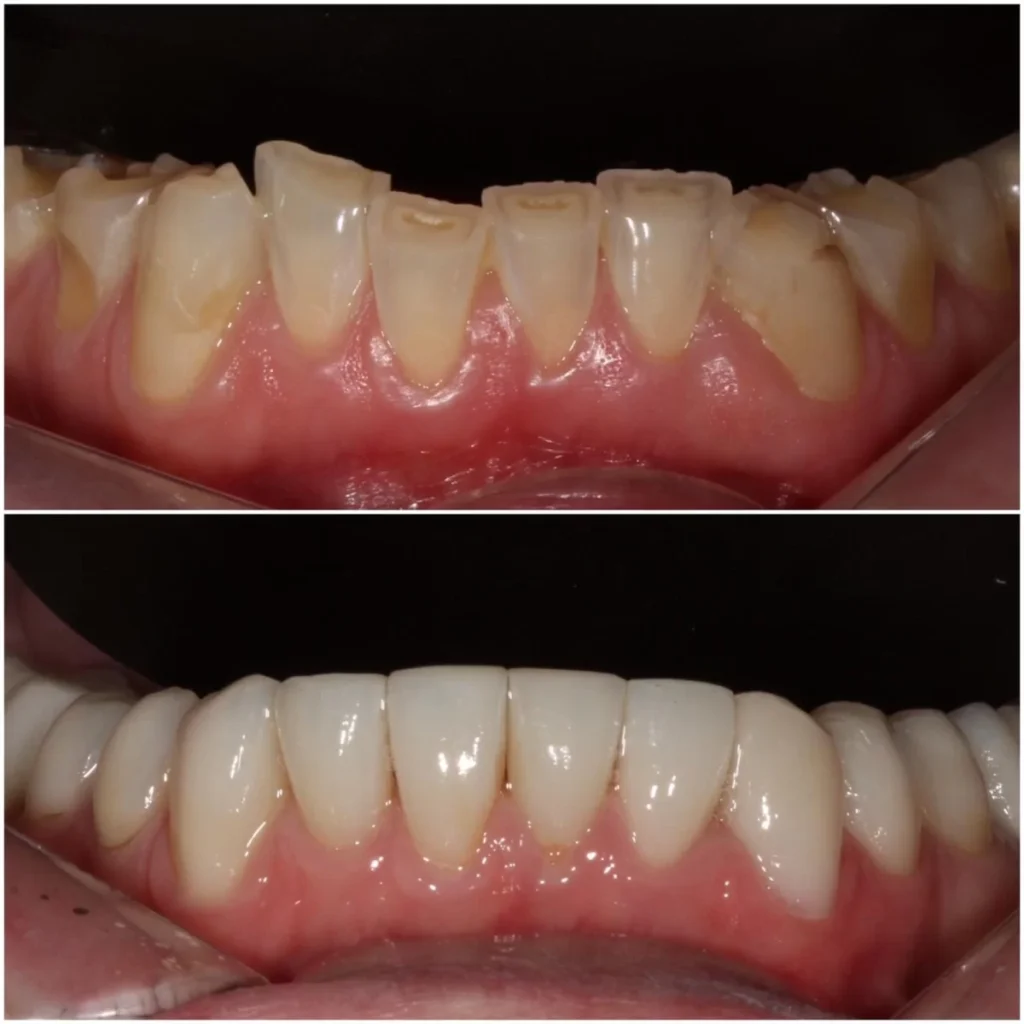 Porcelain veneers to rebuild tooth material lost due to excessive erosion