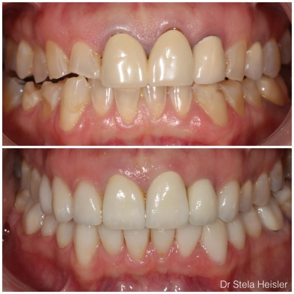 Bruxism (teeth grinding) - before and after photo