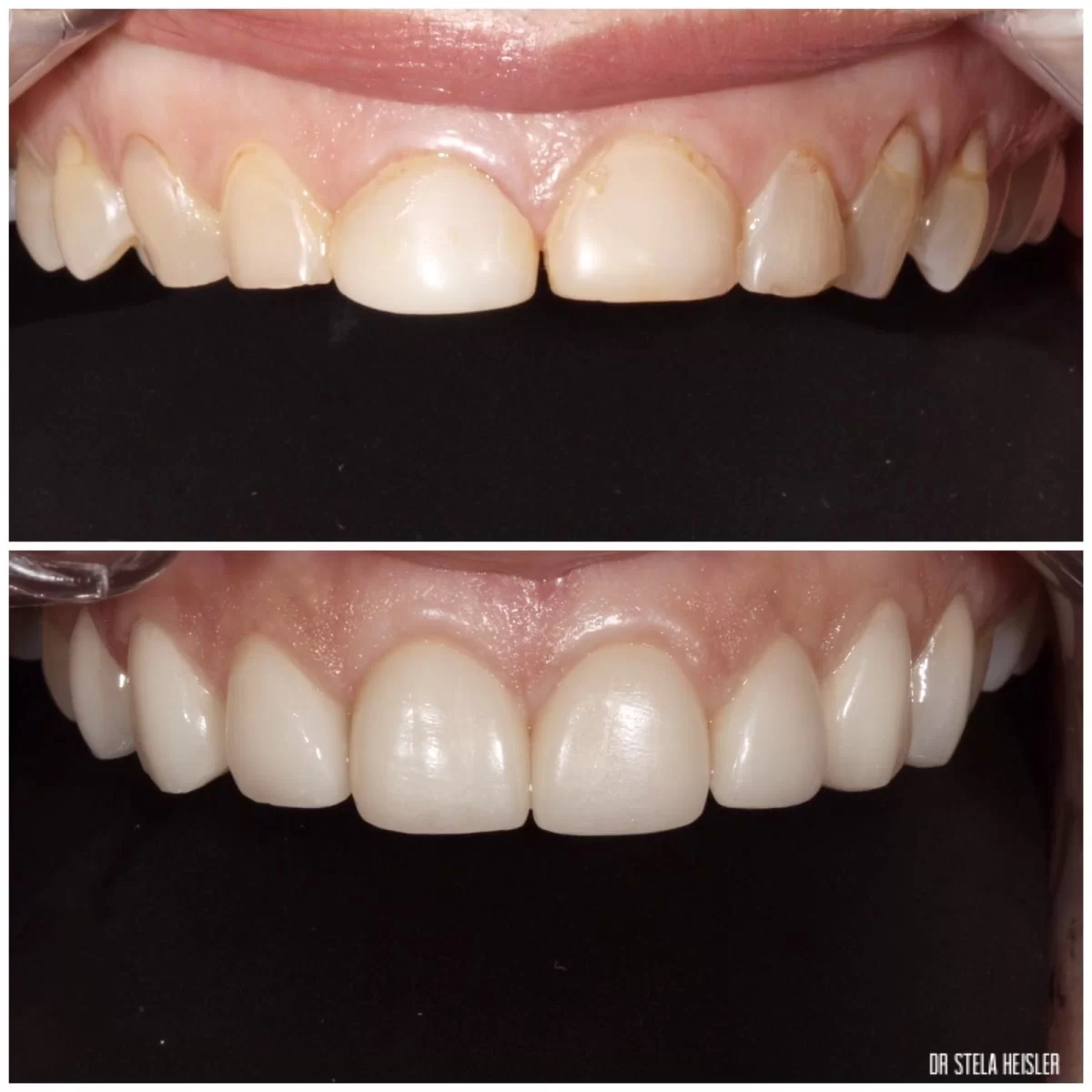 ציפוי שיניים זירקוניה תמונות לפני ואחרי