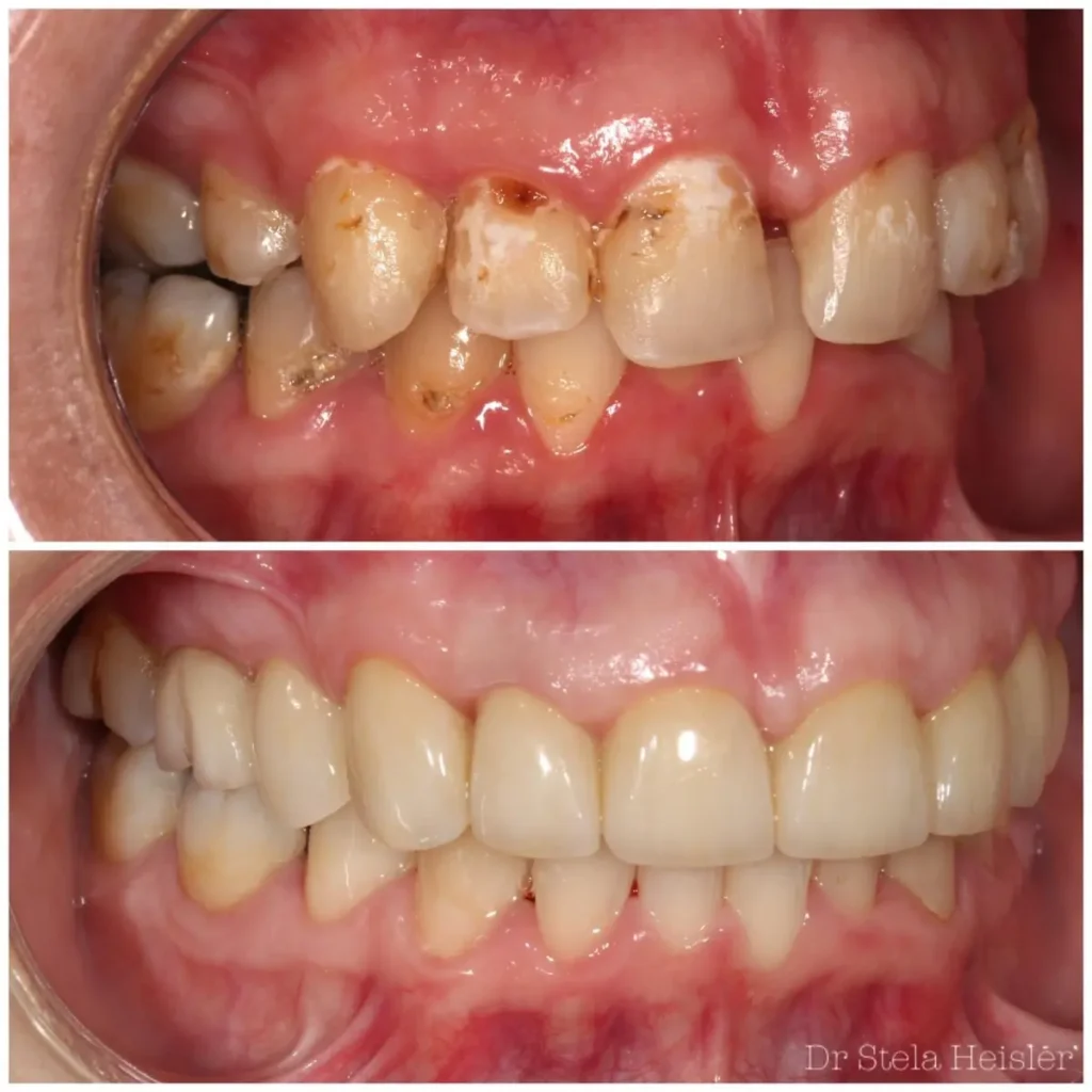 Full Mouth Reconstruction - Dental Clinic in Jerusalem