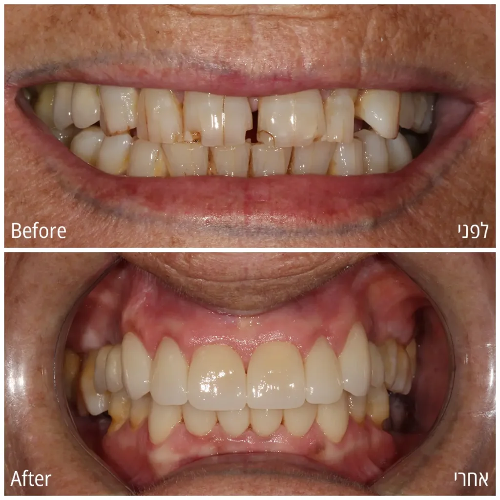 6 upper porcelain veneers and 6 lower porcelain veneers