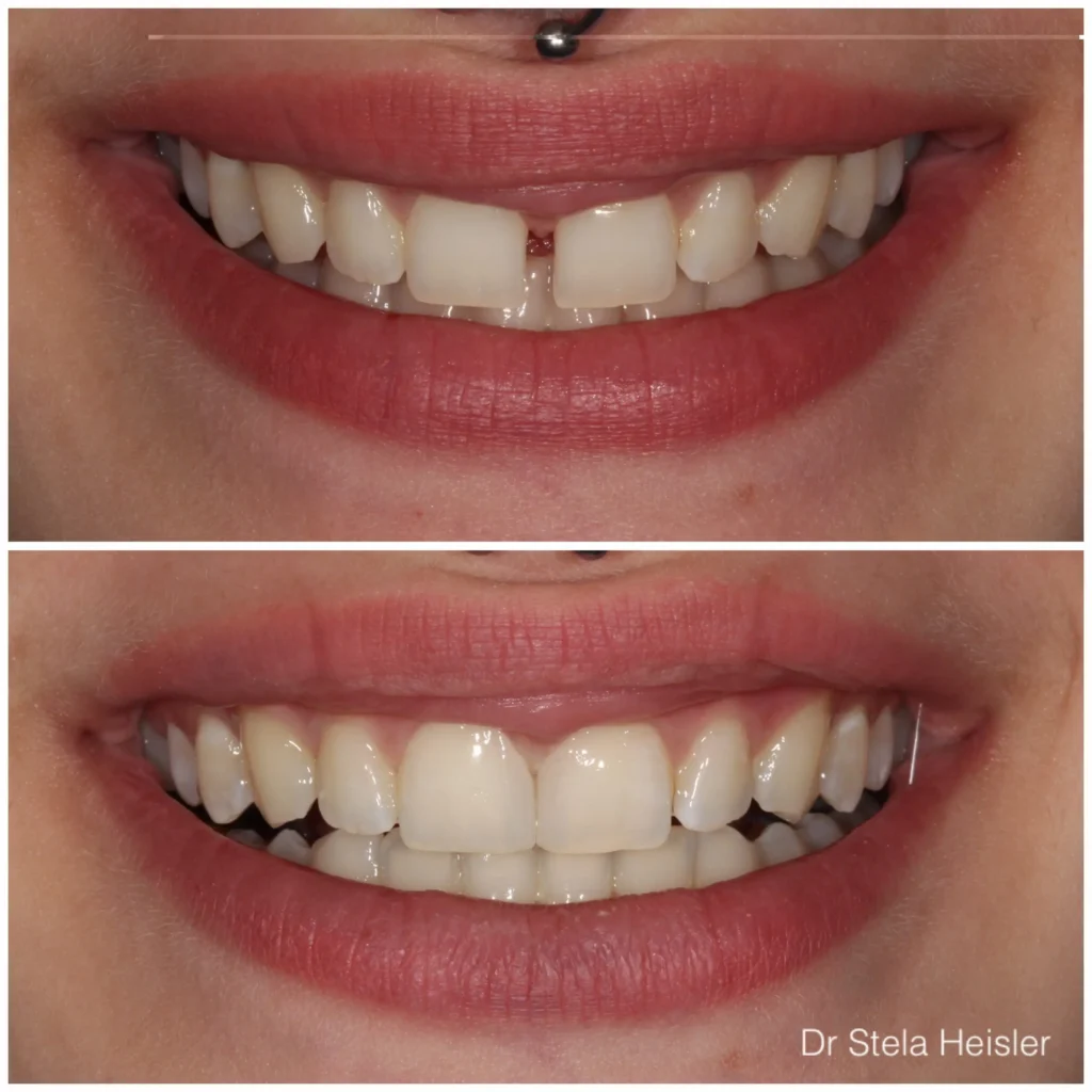 Composite veneer for closing a front gap