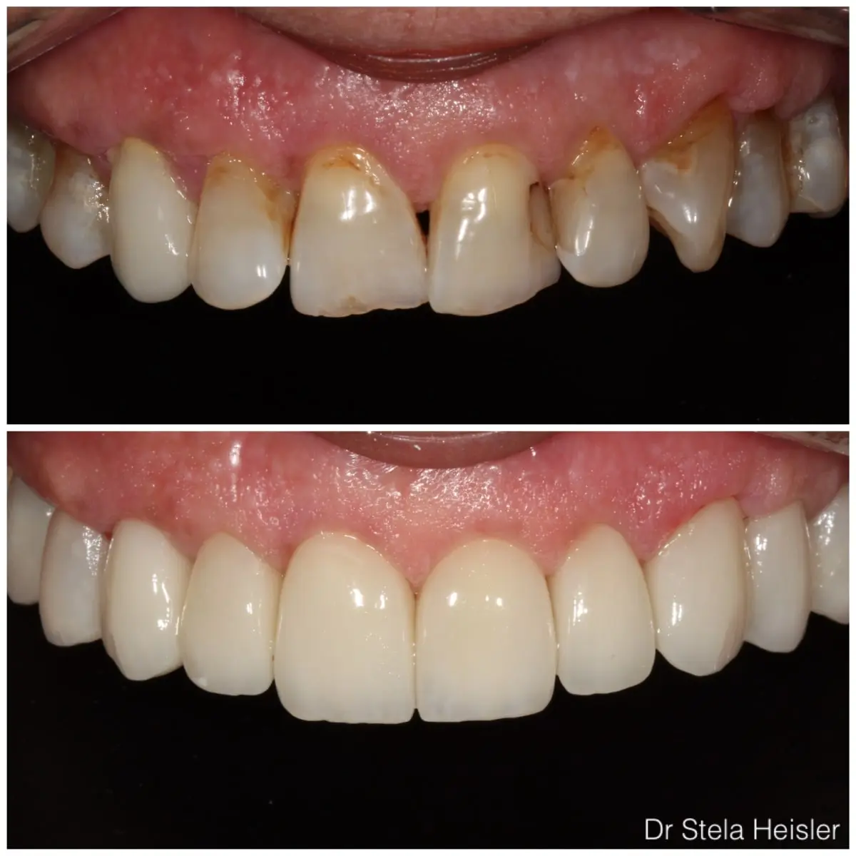 Porcelain veneers for shape correction and color improvement of teeth